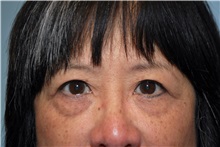 Eyelid Surgery After Photo by Kristoffer Ning Chang, MD; San Francisco, CA - Case 31238