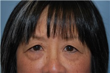 Eyelid Surgery Before Photo by Kristoffer Ning Chang, MD; San Francisco, CA - Case 31238