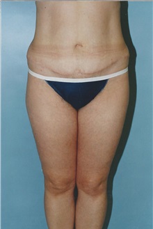 Tummy Tuck After Photo by Kristoffer Ning Chang, MD; San Francisco, CA - Case 32597