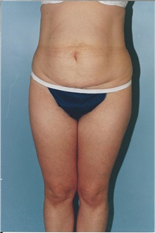 Tummy Tuck Before Photo by Kristoffer Ning Chang, MD; San Francisco, CA - Case 32597