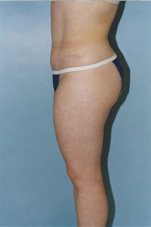 Tummy Tuck After Photo by Kristoffer Ning Chang, MD; San Francisco, CA - Case 32597