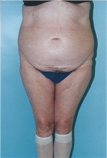 Tummy Tuck Before Photo by Kristoffer Ning Chang, MD; San Francisco, CA - Case 32600
