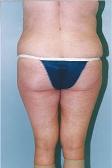 Tummy Tuck After Photo by Kristoffer Ning Chang, MD; San Francisco, CA - Case 32600