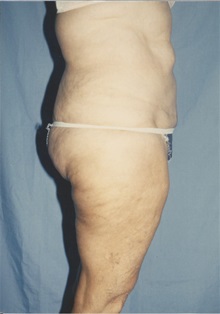 Tummy Tuck After Photo by Kristoffer Ning Chang, MD; San Francisco, CA - Case 32601