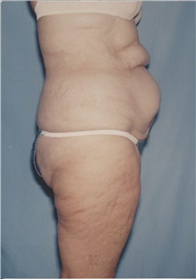Tummy Tuck Before Photo by Kristoffer Ning Chang, MD; San Francisco, CA - Case 32601