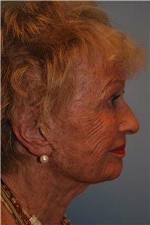 Facelift Before Photo by Kristoffer Ning Chang, MD; San Francisco, CA - Case 32602