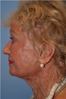 Facelift After Photo by Kristoffer Ning Chang, MD; San Francisco, CA - Case 32602