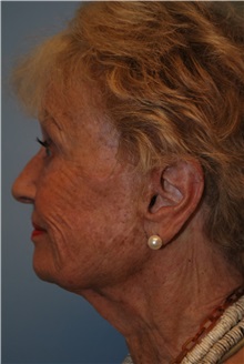 Facelift Before Photo by Kristoffer Ning Chang, MD; San Francisco, CA - Case 32602