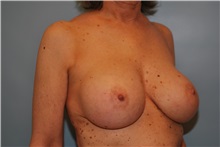 Breast Implant Removal Before Photo by Kristoffer Ning Chang, MD; San Francisco, CA - Case 35517