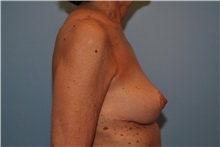 Breast Implant Removal After Photo by Kristoffer Ning Chang, MD; San Francisco, CA - Case 35517