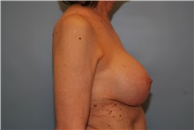 Breast Implant Removal Before Photo by Kristoffer Ning Chang, MD; San Francisco, CA - Case 35517