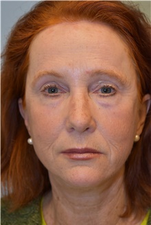 Facelift After Photo by Kristoffer Ning Chang, MD; San Francisco, CA - Case 39359