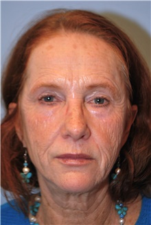 Facelift Before Photo by Kristoffer Ning Chang, MD; San Francisco, CA - Case 39359