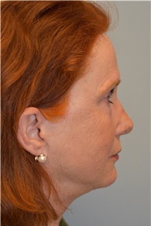 Facelift After Photo by Kristoffer Ning Chang, MD; San Francisco, CA - Case 39359