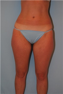 Liposuction Before Photo by Kristoffer Ning Chang, MD; San Francisco, CA - Case 41784