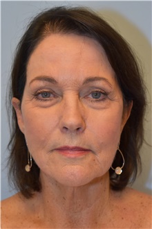Facelift Before Photo by Kristoffer Ning Chang, MD; San Francisco, CA - Case 42712