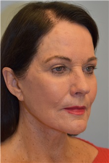 Facelift After Photo by Kristoffer Ning Chang, MD; San Francisco, CA - Case 42712