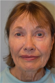 Facelift Before Photo by Kristoffer Ning Chang, MD; San Francisco, CA - Case 42796