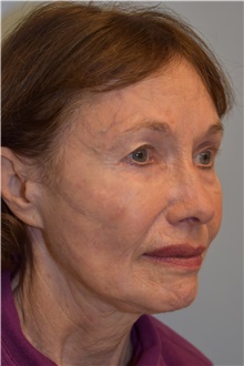Facelift After Photo by Kristoffer Ning Chang, MD; San Francisco, CA - Case 42796