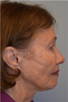 Facelift After Photo by Kristoffer Ning Chang, MD; San Francisco, CA - Case 42796