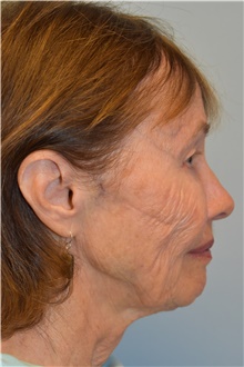 Facelift Before Photo by Kristoffer Ning Chang, MD; San Francisco, CA - Case 42796