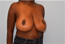 Breast Reduction After Photo by Kristoffer Ning Chang, MD; San Francisco, CA - Case 44768