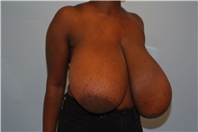 Breast Reduction Before Photo by Kristoffer Ning Chang, MD; San Francisco, CA - Case 44768