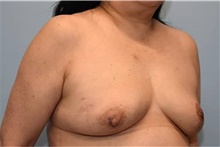 Breast Reconstruction After Photo by Kristoffer Ning Chang, MD; San Francisco, CA - Case 46006