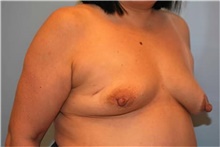 Breast Reconstruction Before Photo by Kristoffer Ning Chang, MD; San Francisco, CA - Case 46006