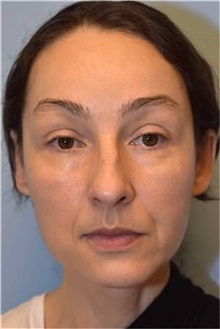 Rhinoplasty Before Photo by Kristoffer Ning Chang, MD; San Francisco, CA - Case 46008