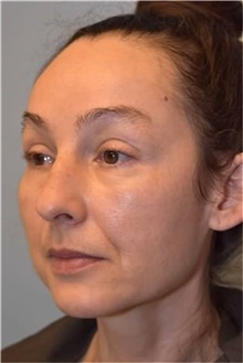 Rhinoplasty After Photo by Kristoffer Ning Chang, MD; San Francisco, CA - Case 46008