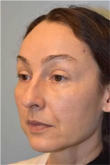 Rhinoplasty Before Photo by Kristoffer Ning Chang, MD; San Francisco, CA - Case 46008