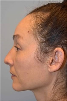 Rhinoplasty After Photo by Kristoffer Ning Chang, MD; San Francisco, CA - Case 46008