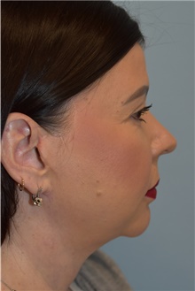 Facelift After Photo by Kristoffer Ning Chang, MD; San Francisco, CA - Case 46231