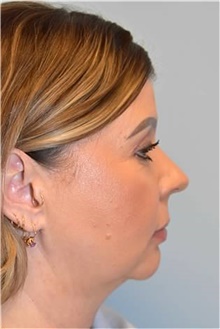Facelift Before Photo by Kristoffer Ning Chang, MD; San Francisco, CA - Case 46231