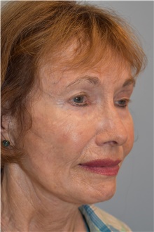 Neck Lift After Photo by Kristoffer Ning Chang, MD; San Francisco, CA - Case 46960
