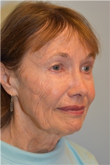 Neck Lift Before Photo by Kristoffer Ning Chang, MD; San Francisco, CA - Case 46960