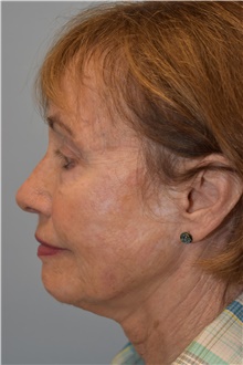 Neck Lift After Photo by Kristoffer Ning Chang, MD; San Francisco, CA - Case 46960