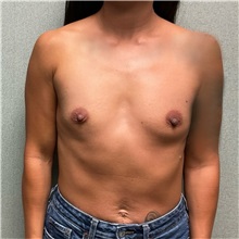 Breast Augmentation Before Photo by Michael Yang, MD; Bettendorf, IA - Case 50585