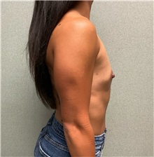 Breast Augmentation Before Photo by Michael Yang, MD; Bettendorf, IA - Case 50585