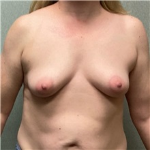 Breast Augmentation Before Photo by Michael Yang, MD; Bettendorf, IA - Case 50586