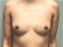 Breast Augmentation Before Photo by Michael Yang, MD; Bettendorf, IA - Case 50587