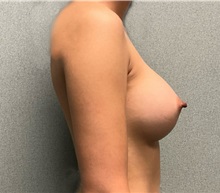 Breast Augmentation After Photo by Michael Yang, MD; Bettendorf, IA - Case 50587