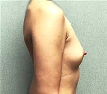 Breast Augmentation Before Photo by Michael Yang, MD; Bettendorf, IA - Case 50587