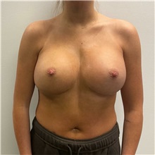 Breast Augmentation After Photo by Michael Yang, MD; Bettendorf, IA - Case 50593