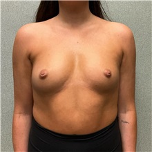Breast Augmentation Before Photo by Michael Yang, MD; Bettendorf, IA - Case 50593
