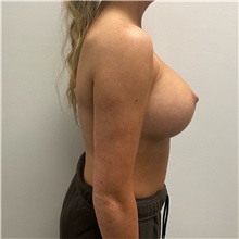Breast Augmentation After Photo by Michael Yang, MD; Bettendorf, IA - Case 50593
