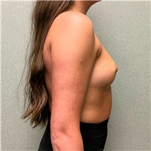 Breast Augmentation Before Photo by Michael Yang, MD; Bettendorf, IA - Case 50593