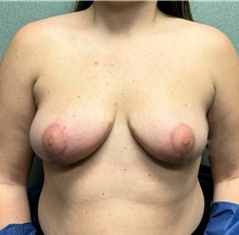 Breast Reduction After Photo by Michael Yang, MD; Bettendorf, IA - Case 50597