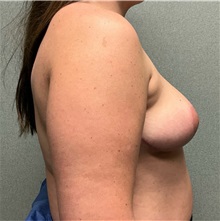 Breast Reduction After Photo by Michael Yang, MD; Bettendorf, IA - Case 50597